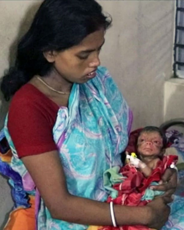 pay-a-baby-boy-who-was-born-with-a-condition-called-progeria-in-bangladesh-3-w600