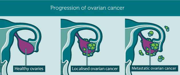 progression_ovariancancer1