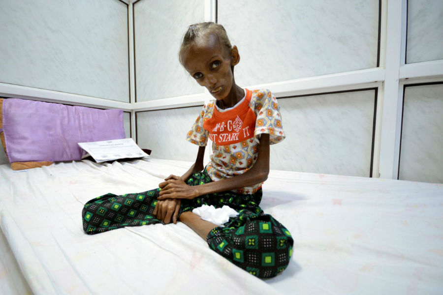 «سایدا احمد بقیلی» دختر 18 ساله ای که از سوءتغذیه شدید رنج می برد روی تخت بیمارستان در یکی از شهرهای یمن نشسته است. 24 اکتبر