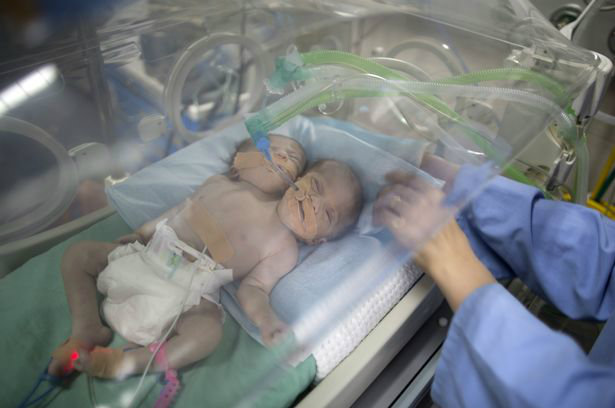 one-day-old-palestinian-conjoined-twin-b-1-w700