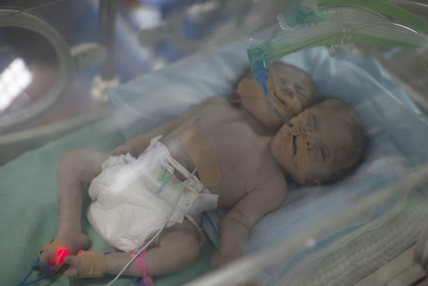 one-day-old-palestinian-conjoined-twin-b-3-w700