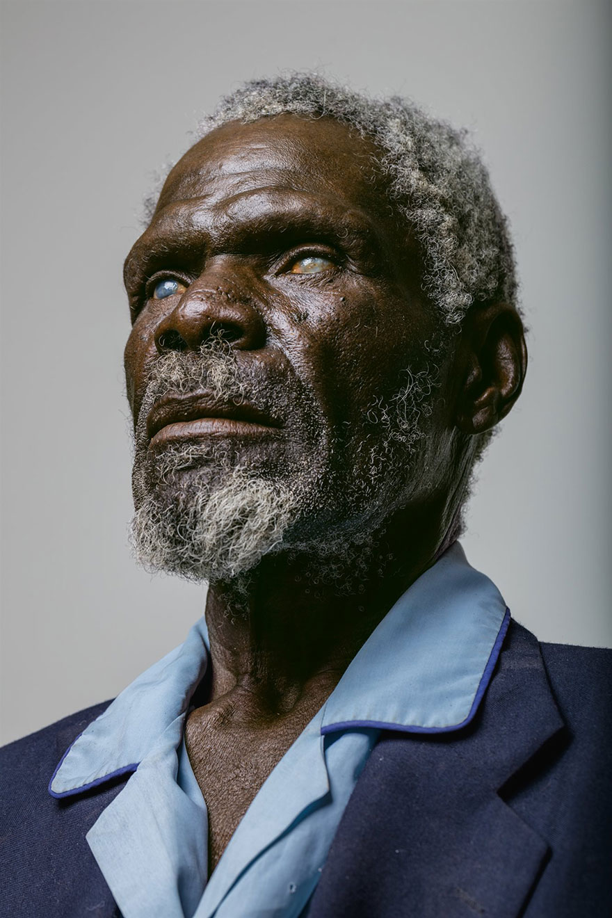 20- «گرد گاماناب»، 67 ساله ای است که در اثر چندین سال کار در میان گرد و غبار و نور مستقیم آفتاب در نامبیا قرنیه چشمانش آسیب دیده و به کوری وی منجر گشته. او می توانست با درمان زودهنگام، از نابینایی خود پیشگیری کند.