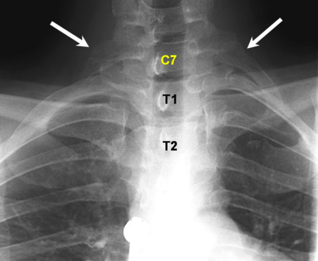 12709510-Cervical-ribs-at-C7-Plain-antero-posterior-radiographs-demonstrate-C7-vertebra-bearing-a-1490957558-650-0dd5a3e69d-1491402134-w700