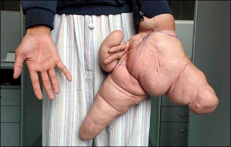 «لوئی هیوآ» از بیماری نادری موسوم به Macrodactyly رنج می برد که به موجب آن، یک بخش از بدن در اندازه ای غیر معمول رشد کرده و عدم تناسبی محسوس را ایجاد می کند. آقای هیوآ به همین خاطر، در تابستان 2007 در یکی از بیمارستان های شانگهای بستری شد. انگشت شست دست چپ وی 26 سانتی متر و انگشت اشاره اش نزدیک به 30.4 سانتی متر بود. در سال 2007 پس از یک جراحی 7 ساعته، حدود 5 کیلوگرم گوشت از دستان او برداشته و دستش به حالت طبیعی خود بازگشت. 