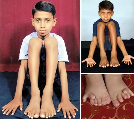 «پرانامیا مناریا» و «دوندرا هارنه» دو فردی هستند که به دلیل داشتن 25 انگشت در دست و پاهای خود (12 انگشت دست و 13 انگشت پا) نامشان در کتاب گینس ثبت شده. دلیل این امر نوعی بیماری به نام «پرانگشتی» است.