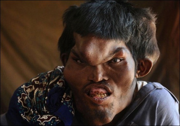 «ساین ممتاز» یک مرد پاکستانی است که از کودکی از سندروم پروتئوس رنج می برده که باعث شده تا صورتی دفرمه و جمجمه ای بزرگ تر از حد معمول داشته باشد. 