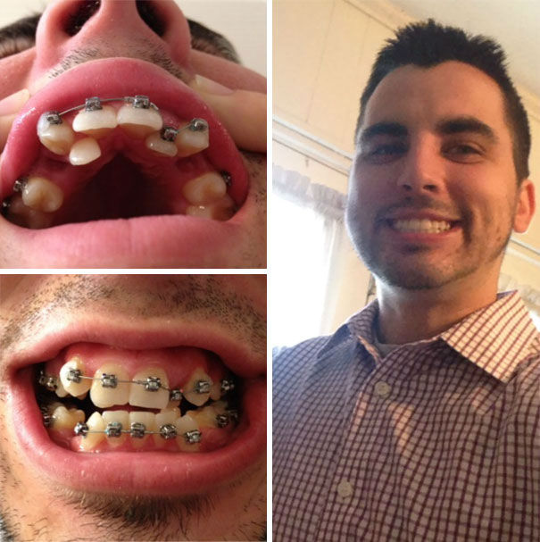 dental-braces-before-after-102-592299e625d83__605-w700