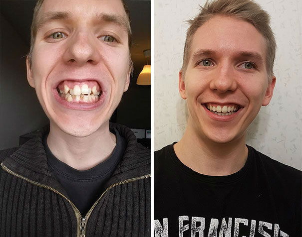 dental-braces-before-after-103-59229a9f86bdd__605-w700
