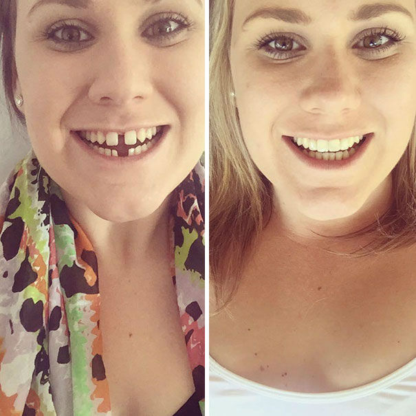 dental-braces-before-after-144-592548764b1eb__605-w700