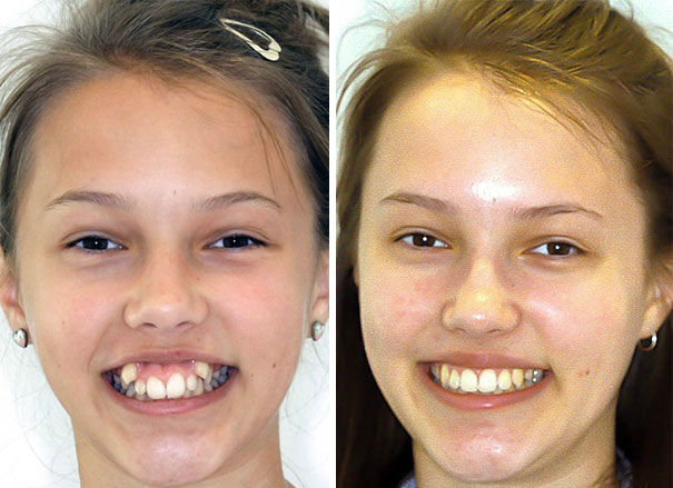 dental-braces-before-after-210-5927f0f4064e3__605-w700