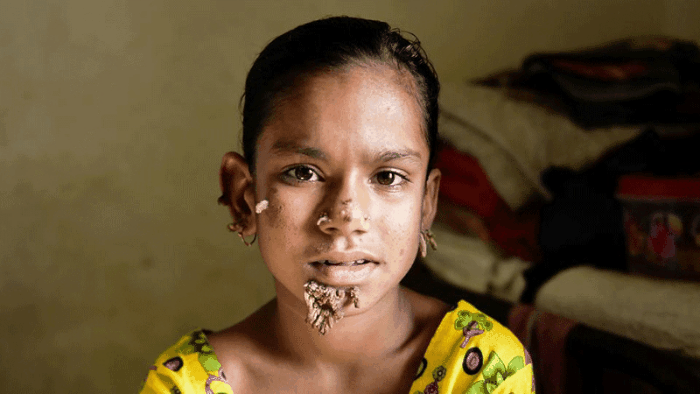دختر بنگلادشی ۱۲ ساله ای که به بیماری نادر « مرد درختی » مبتلا شده است