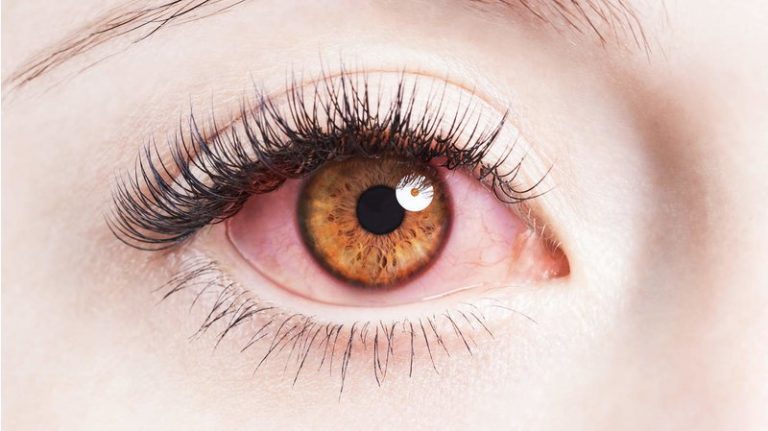چرا چشم ها قرمز می شوند و چگونه می توان آن ها را درمان کرد؟