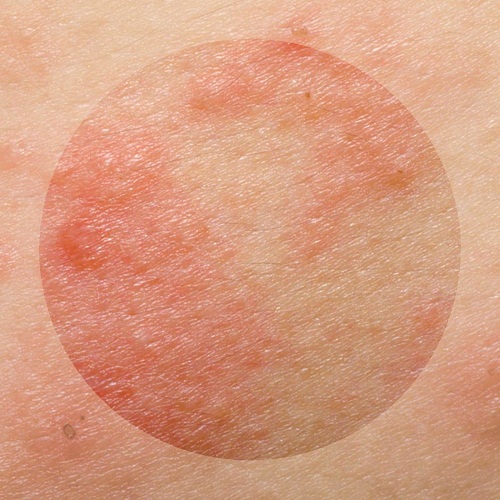 05-eczema-skin-conditions-that-get-worse-when-you-re-stressed-725930335-noppadon-stocker-119583706-pan-xunbin-1200x1200.jpg