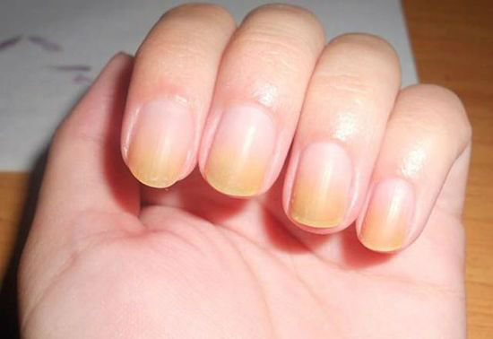 Yellow-nail_GH_content_550px-w700.jpeg