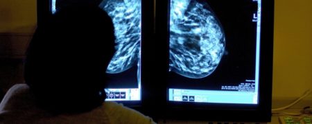 زنان مبتلا به سرطان سینه باید به مدت ۱۰ سال دارو مصرف کنند