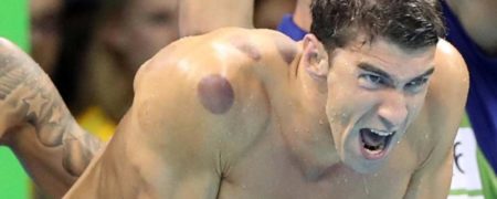 فلپس و لکه‌های بنفش