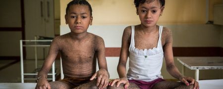 سرنوشت غم انگیز کودکان “پوست ماری” در هند