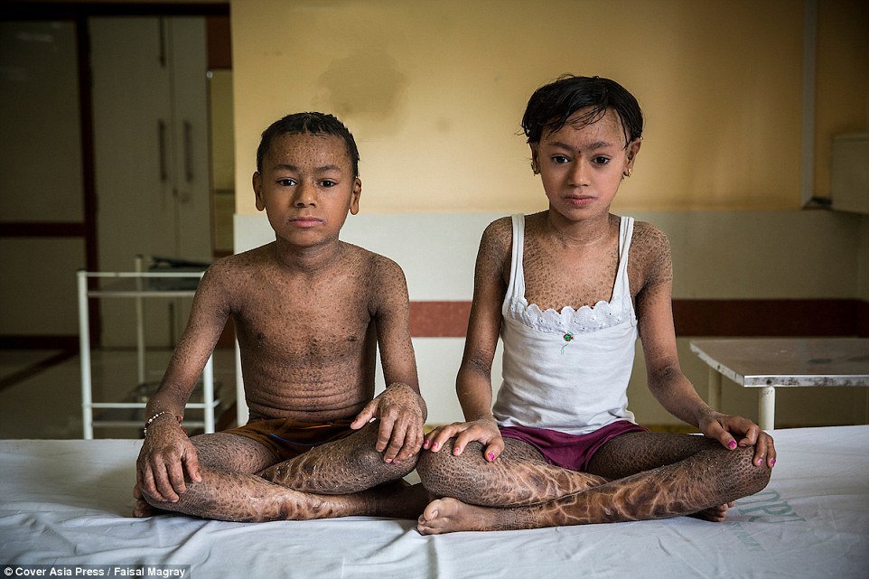 سرنوشت غم انگیز کودکان “پوست ماری” در هند