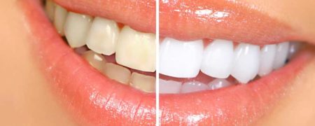 ۱۰ راهکار خانگی برای سفیدکردن دندان ها با مواد طبیعی