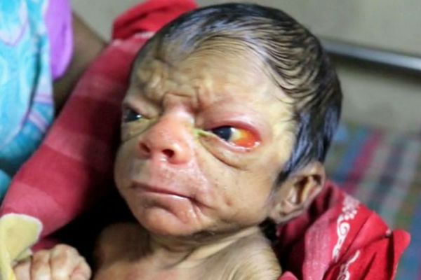 pay-a-baby-boy-who-was-born-with-a-condition-called-progeria-in-bangladesh-2-w600