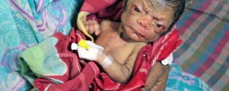 به دنیا آمدن نوزادی نادر که همانند انسان های ۸۰ ساله به نظر می رسد