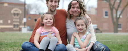 زنی که برای زنده ماندن مجبور شد نصف صورتش را جراحی کند