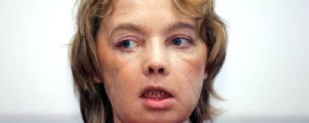 نخستین دریافت کننده پیوند صورت، درگذشت