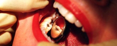 داشتن بیش از ۸ دندان پر شده خطر ابتلا به بیماری های قلبی و کلیوی را افزایش می دهد