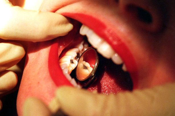داشتن بیش از ۸ دندان پر شده خطر ابتلا به بیماری های قلبی و کلیوی را افزایش می دهد
