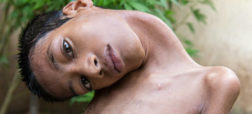 معجزه در هند؛ روایت زندگی پسر بچه ای که سرش ۱۸۰ درجه چرخیده بود