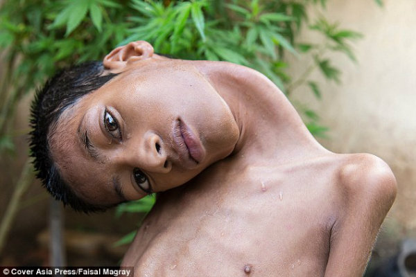 معجزه در هند؛ روایت زندگی پسر بچه ای که سرش ۱۸۰ درجه چرخیده بود