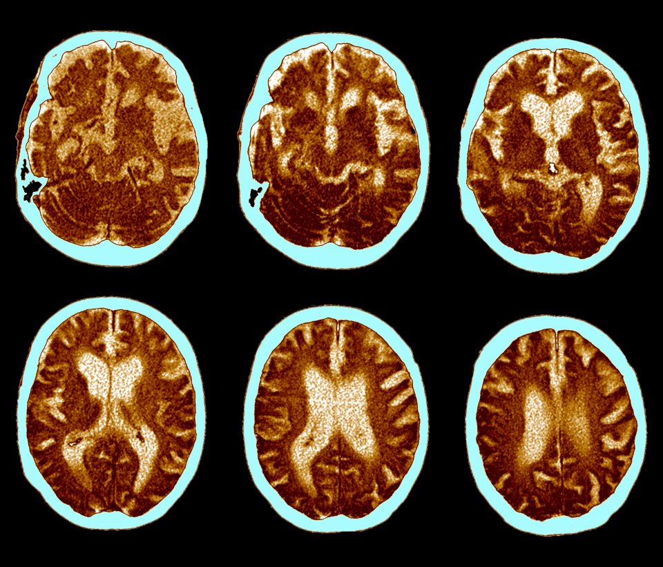 CAT scan of brain, Alzheimer's disease
