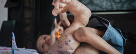 اختلال ژنتیکی نادر؛ پسری که پای راستش ۴ برابر اندازه عادی است