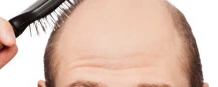 استرس چگونه می تواند بر ریزش موی سر تاثیرگذار باشد؟ [تماشا کنید-زیرنویس فارسی]