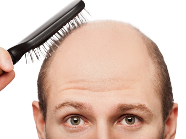استرس چگونه می تواند بر ریزش موی سر تاثیرگذار باشد؟ [تماشا کنید-زیرنویس فارسی]