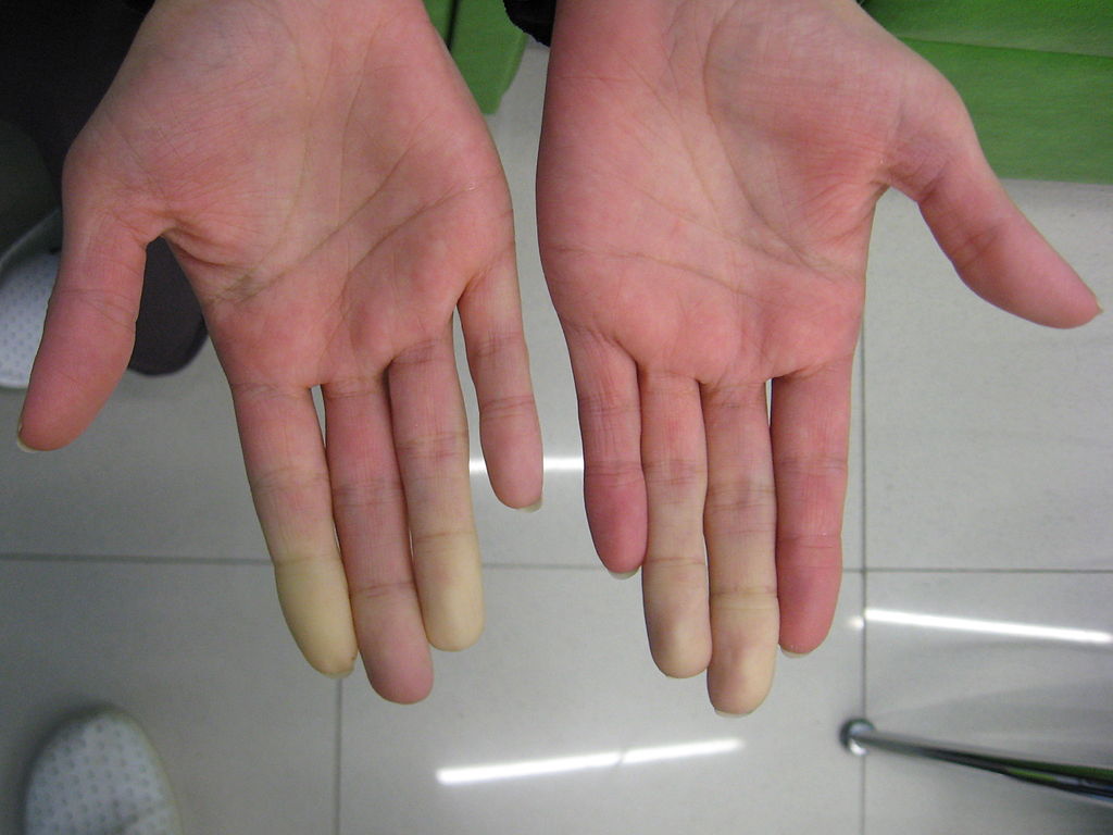 secondary_raynauds_in_sjogrens_syndrome_1