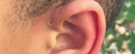 چرا برخی افراد کنار گوش خود یک حفره کوچک دارند؟ [تماشا کنید-زیرنویس فارسی]