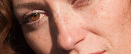 ۵ راهکار خانگی و ۲ راهکار پزشکی برای رفع لک های تیره پوست