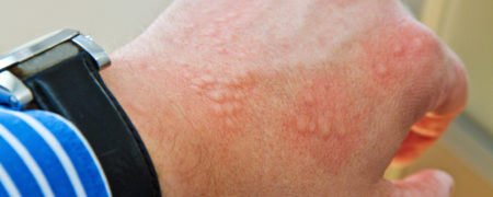 موارد و اشیایی که هرگز تصور نمی کردید سبب شوند بدن شما دچار حساسیت گردد