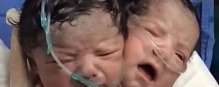 عجایب جهان؛ تولد یک کودک با دو سر در مکزیک [تماشا کنید]