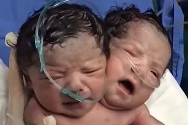 عجایب جهان؛ تولد یک کودک با دو سر در مکزیک [تماشا کنید]