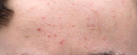 چگونه با راهکارها و ماسک های خانگی، انواع و اقسام جوش ها و کورک ها را از پوست پاکسازی کنیم؟