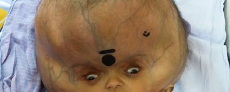 بیماری نادر و عجیب؛ کودک هندی که سرش به اندازه یک هندوانه رشد کرده است