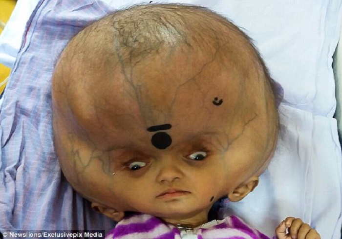 بیماری نادر و عجیب؛ کودک هندی که سرش به اندازه یک هندوانه رشد کرده است