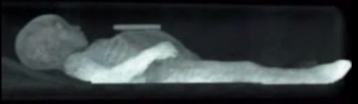 تصویر اشعه ایکس حالت دست ها و پاهای زیبای خفته را نشان می دهند. 