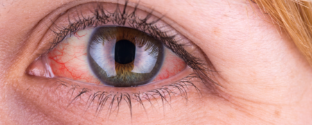 دلایل قرمزی بیش از اندازه چشم ها و راهکارهایی برای پیشگیری از این موضوع