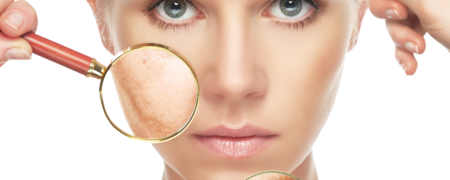 آنچه باید در مورد عارضه ای پوستی به نام «روزاسه» بدانید