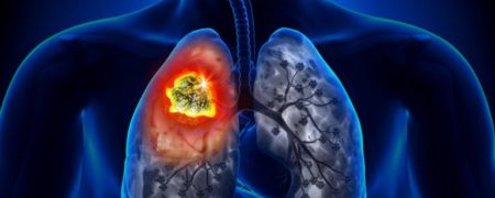 با شایع ترین نشانه های سرطان ریه آشنا شوید