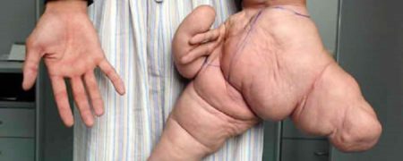 ۶ اختلال ژنتیکی نادر و بسیار عجیب که شما را به حیرت وا می دارند