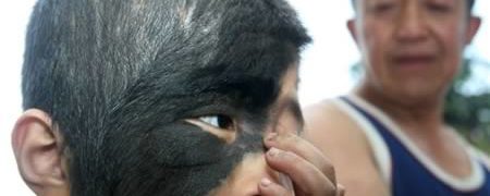 9 نمونه از عجیب ترین و حیرت انگیز ترین علامت های مادرزادی که تا به حال دیده شده اند